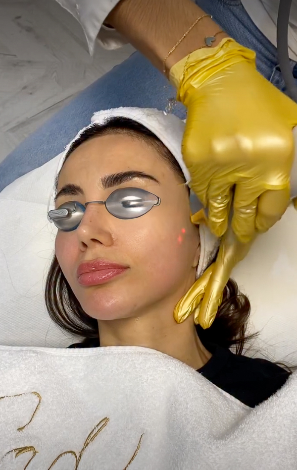 Photo-Rejuvenation (IPL), IG @sadaf_jaffari | Treatwell